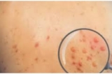 bệnh đậu mùa khỉ