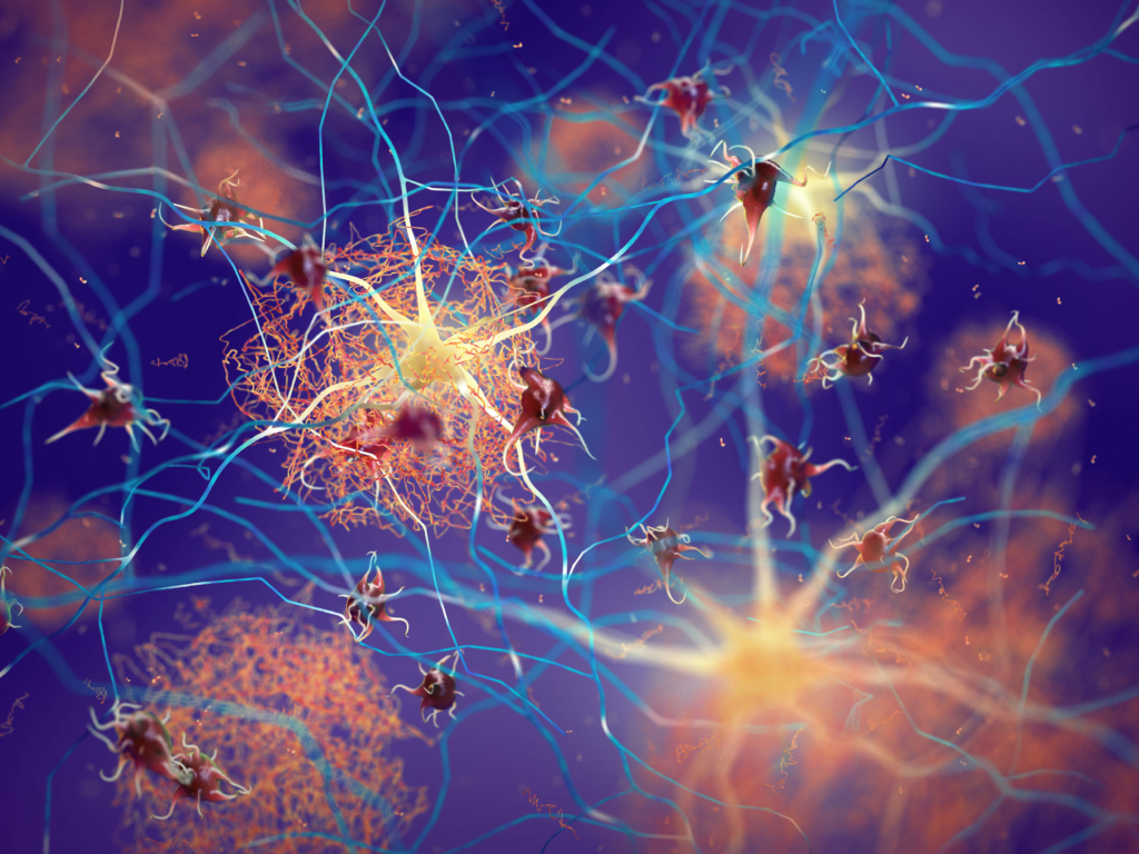 Các mảng amyloid hình thành giữa các tế bào thần kinh. (Ảnh: Shutterstock)