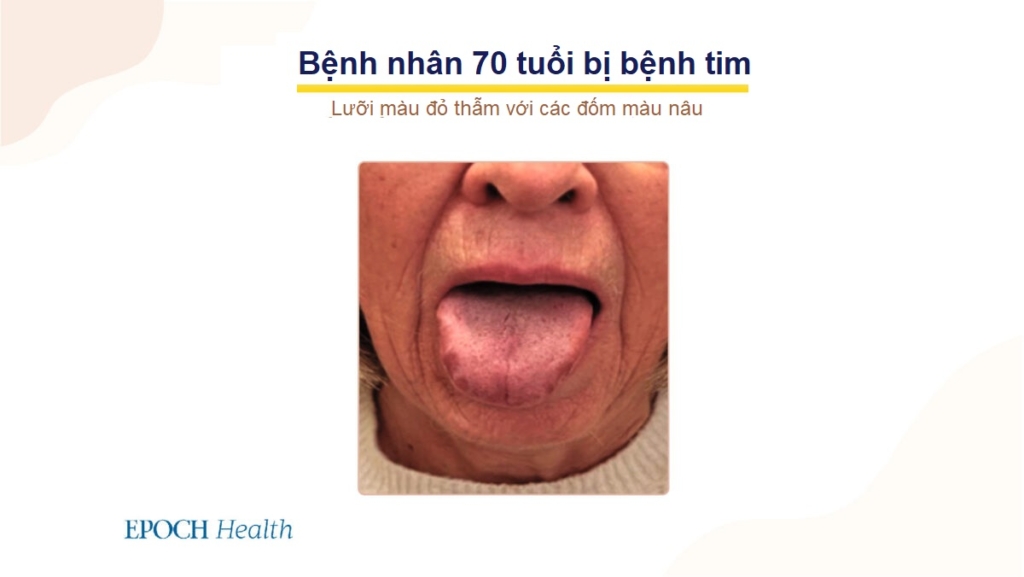 COVID-19 làm tăng nguy cơ bị bệnh tim – Các dấu hiệu nguy cấp và mẹo để phòng ngừa