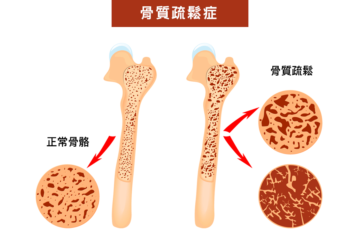 Khi tuổi tác tăng lên, loãng xương và mất xương là những vấn đề mà cả nam và nữ đều phải đối mặt. (Ảnh: Shutterstock/Epoch Times)