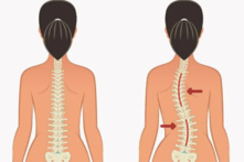 Tư thế không đúng dễ gây cong vẹo cột sống. Cách điều chỉnh? (Ảnh: Shutterstock)
