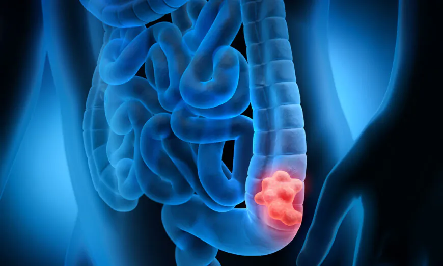 Điều quan trọng là phát hiện được polyp trước khi chúng trở thành ung thư. (Ảnh: peterschreiber.media/Shutterstock)