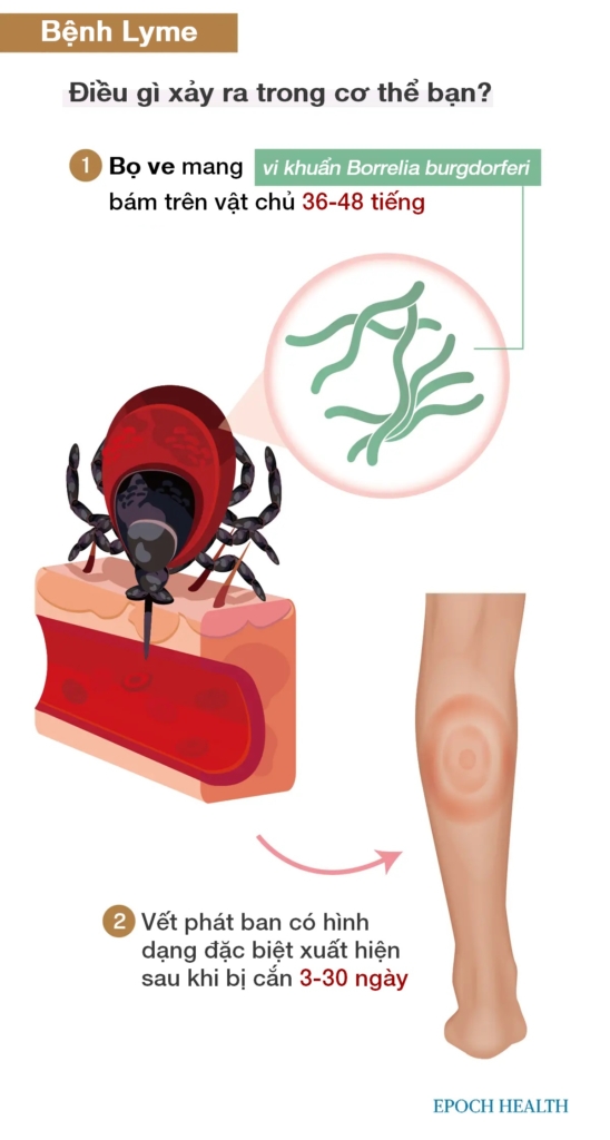 Hướng dẫn cơ bản về bệnh Lyme: Triệu chứng, nguyên nhân, điều trị, và cách tiếp cận tự nhiên