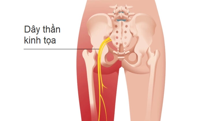 Tôi đã chữa lành chứng đau thần kinh tọa như thế nào